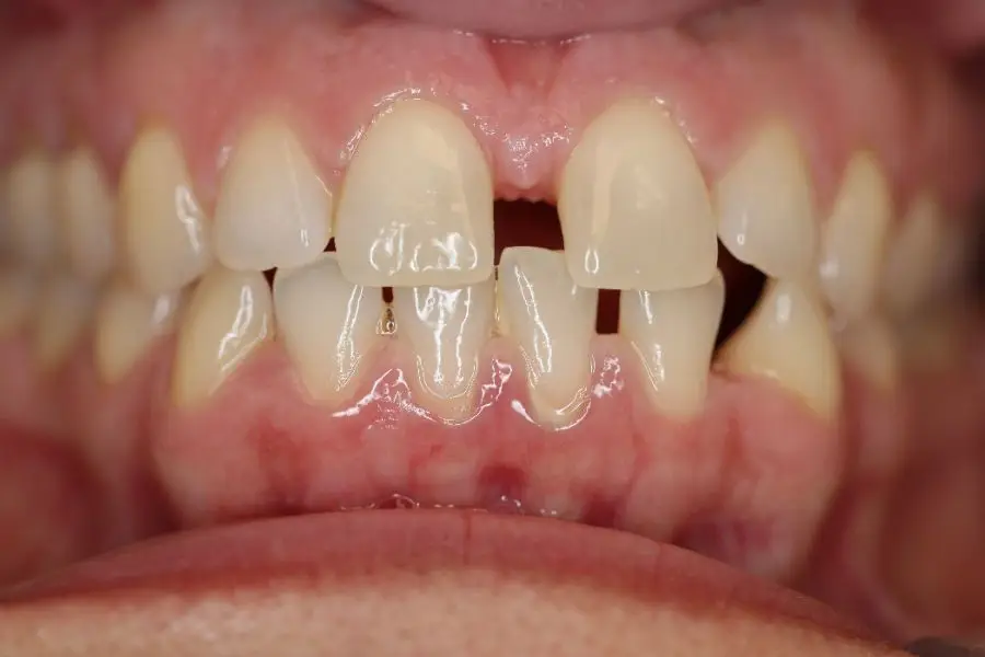 felnőtt fogszabályozás kép előtte