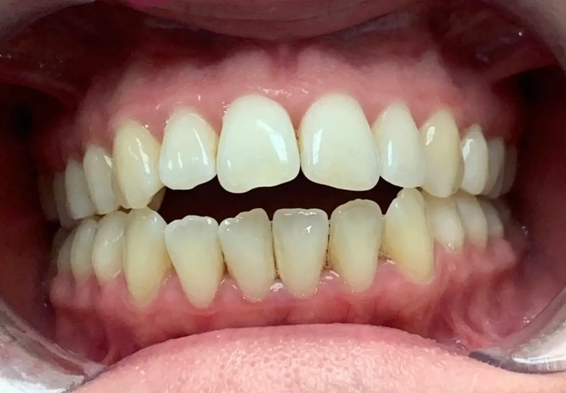 Invisalign eset 1 előtte