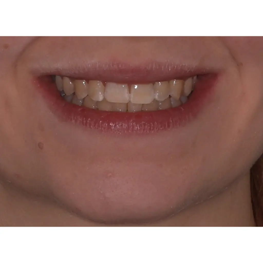 invisalign készülék utána