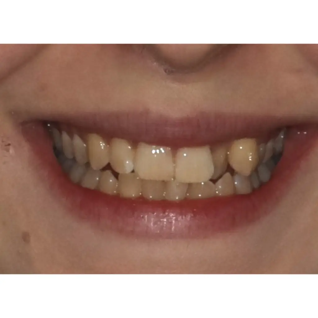 invisalign készülék előtte